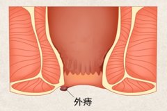 肛门损伤